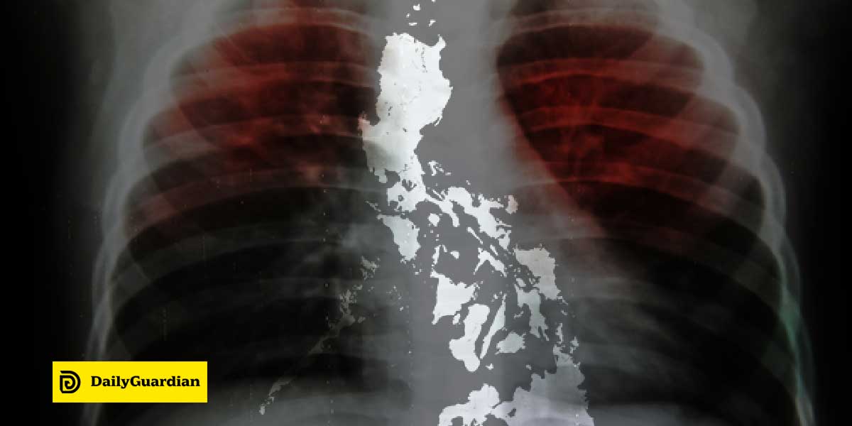 Tuberculosis in the Philippines and what you need to know