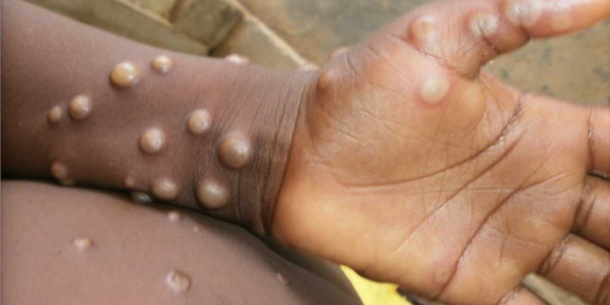 ‘NO MONKEY BUSINESS’: lloilo City gears up for monkeypox virus