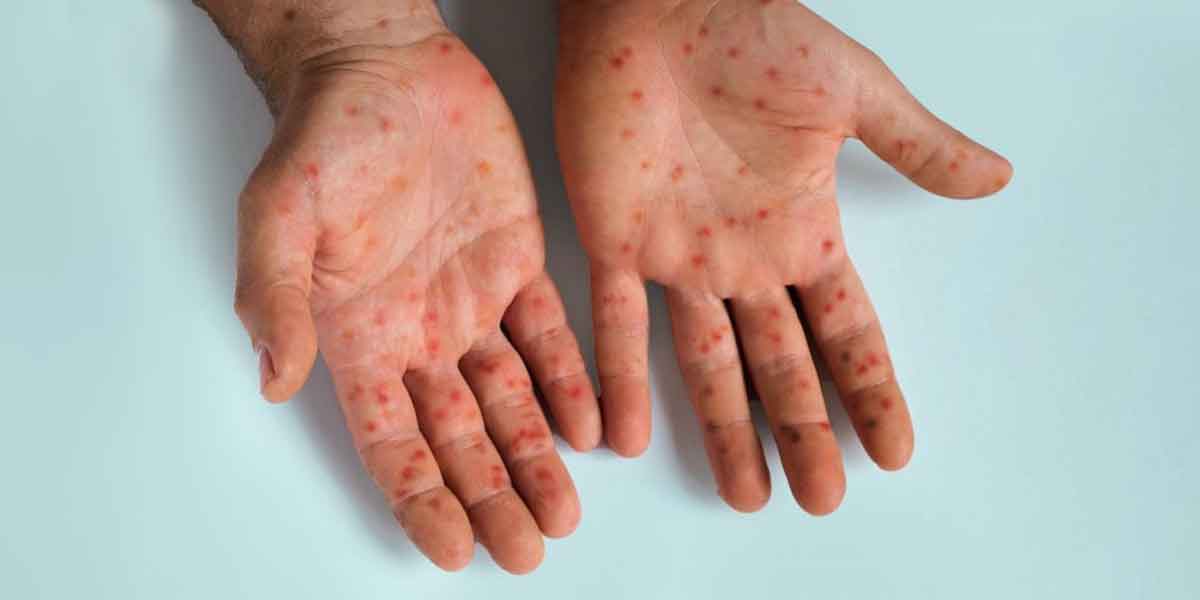 Bacolod City reactivates mpox monitoring team